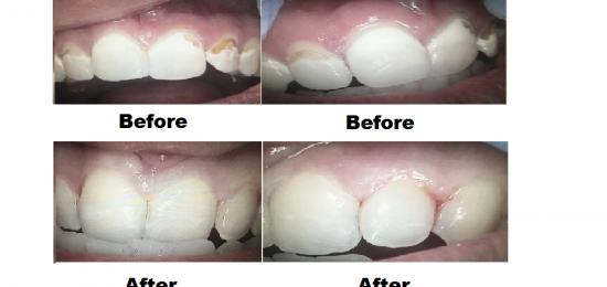 Before and After Smile Gallery