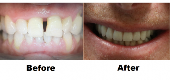 Before and After Smile Gallery