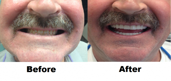 Before and After Smile Gallery