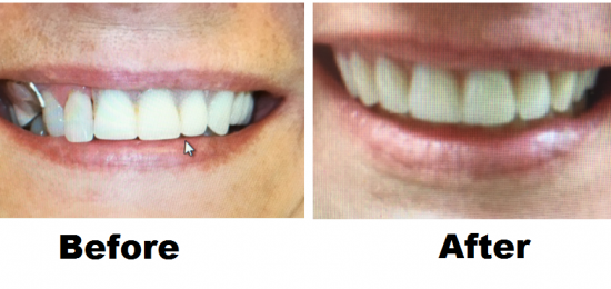 Before and After Smile Gallery