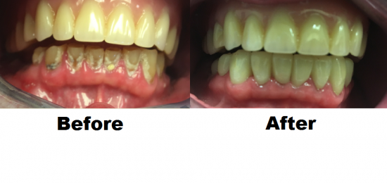 Before and After Smile Gallery