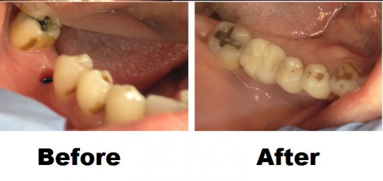 Before and After Smile Gallery