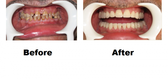 Before and After Smile Gallery