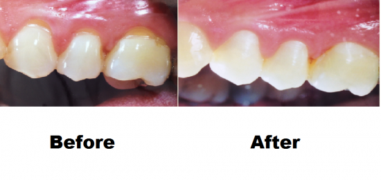 Before and After Smile Gallery