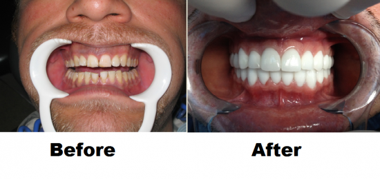 Before and After Smile Gallery