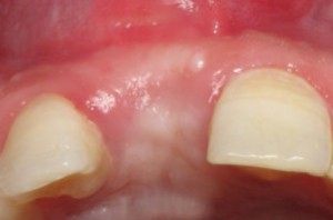 Carlsbad Dental Associates - Bone Grafting