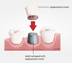 Dental crown procedure