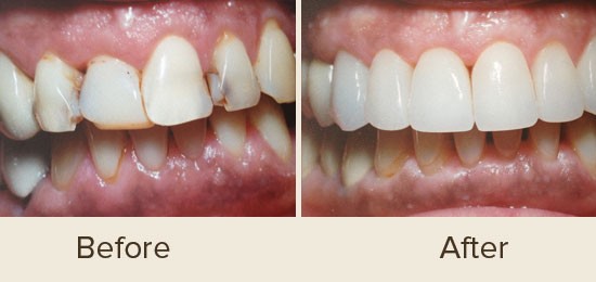 Before and After Smile Gallery