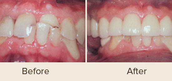 Before and After Smile Gallery