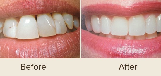 Before and After Smile Gallery