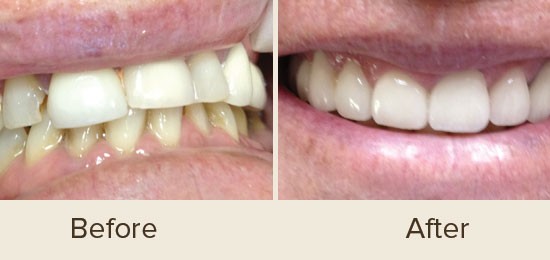 Before and After Smile Gallery