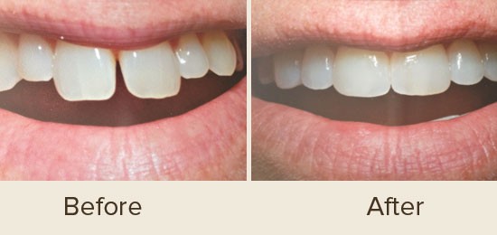 Before and After Smile Gallery