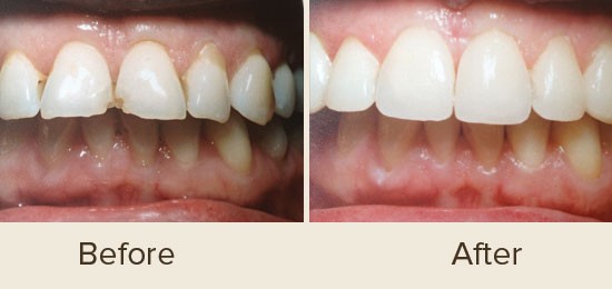 Before and After Smile Gallery